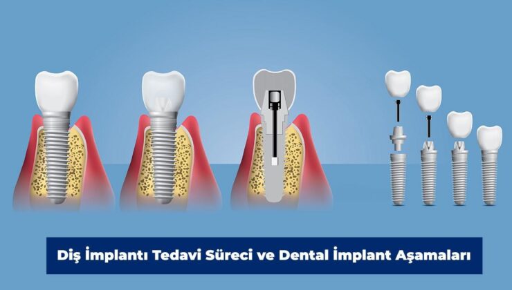 Diş İmplantı Tedavi Süreci ve Dental İmplant Aşamaları