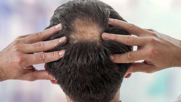 Saç Dökülmesinde Devrim: En Yeni Teknolojiler