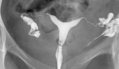 HSG Filmi nedir, neden çekilir?