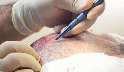 FUE (Follicular Unit Extraction) Tekniği