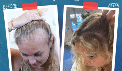 Saç ekimi kimler için uygundur?