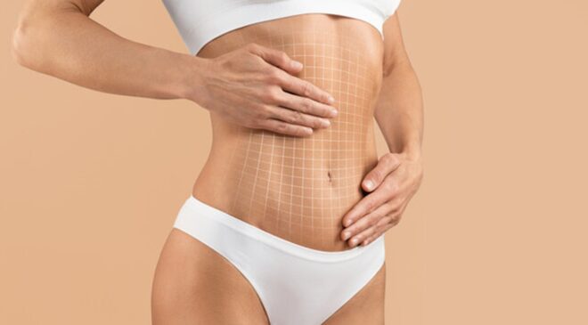 Yeni Nesil Liposuction Yöntemleri ile Net Vücut Hatları
