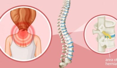 Bel Fıtığından Boyun Fıtığına: Omurga Cerrahisinde Sık Sorulan Sorular