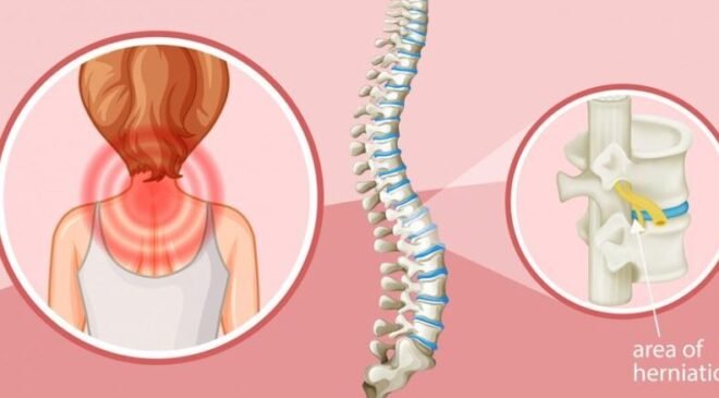 Bel Fıtığından Boyun Fıtığına: Omurga Cerrahisinde Sık Sorulan Sorular