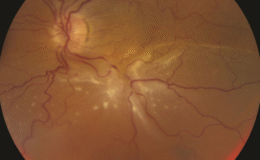 Retina yırtılması hangi belirtilerle kendini gösterebilir?